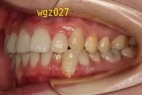 思考她的下颌尖牙如何排入牙列的原创