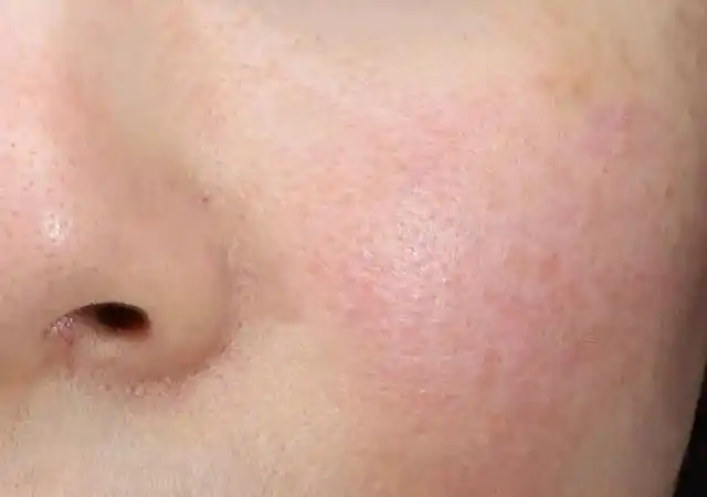 敏感肌如何修复?修复期有多长?_手机搜狐网