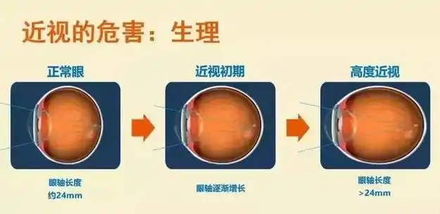 斜视|近视眼|阿托品|高度近视_网易订阅