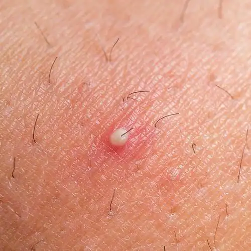 二哥细菌性毛囊炎