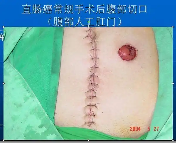 胃肠道肿瘤 结直肠癌 甲状腺结节--腔镜微创手术治疗2