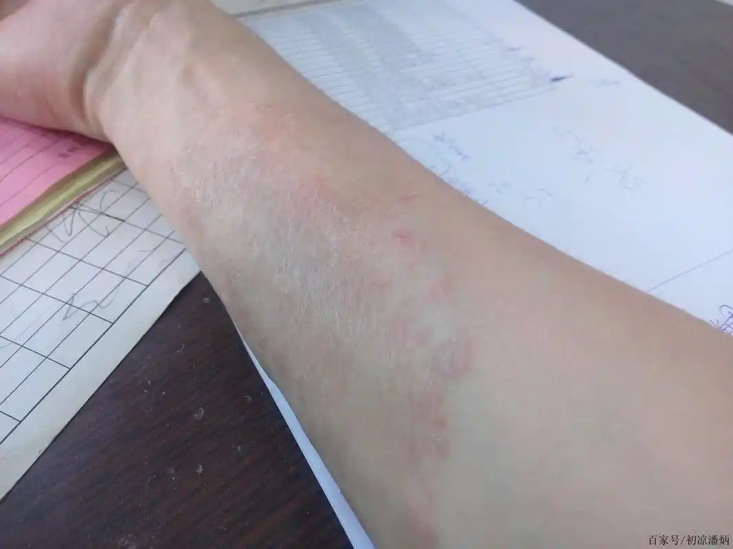 过敏性皮炎与湿疹有什么区别?