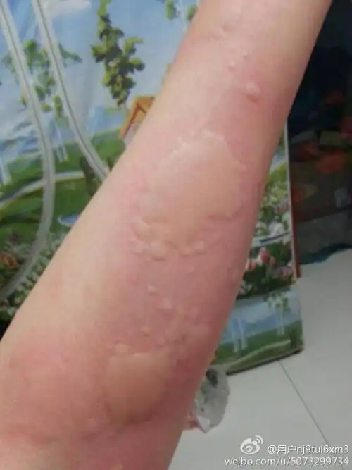 们皮肤过敏要怎么治了 .