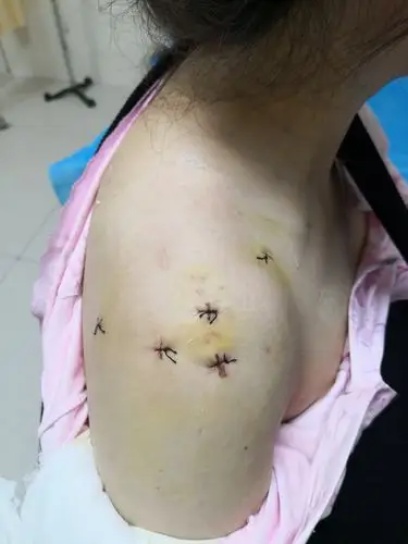 肩袖撕裂治疗——全关节镜下肩袖撕裂缝合桥式缝合修补术