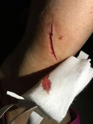 脚被刀片割了,需要打破伤风吗,这是半夜我自己用纱布包了一下