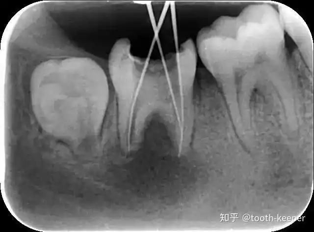 右下第二磨牙慢性根尖炎一例