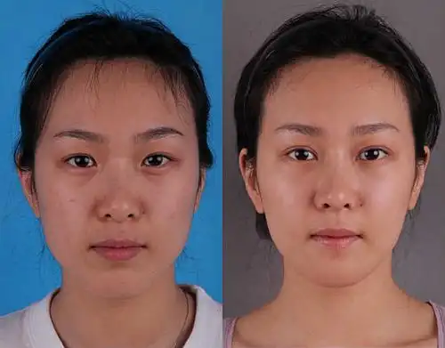 【华韩员工整形秀】苏婉:自体脂肪填充——我的肥肉我做主(图)