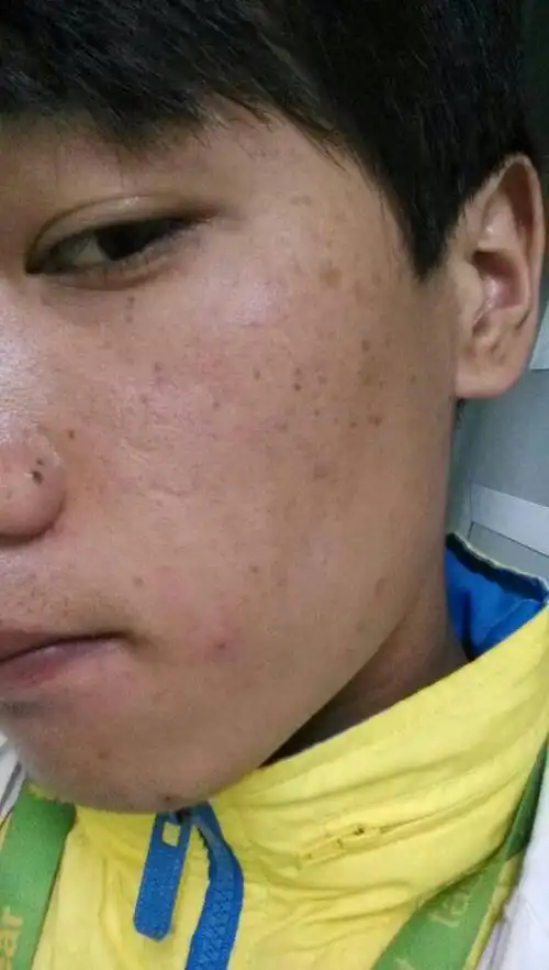 谁的皮肤经历过这种 脸粗糙 有雀斑 痘印 痣 还黑黑的 经历过的球大神