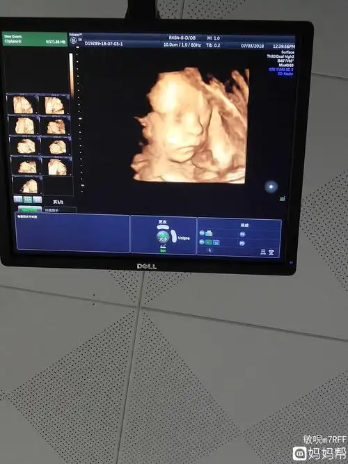 生机勃勃!六个月四维彩超男孩图"一往无前"-第2张图片-途威网