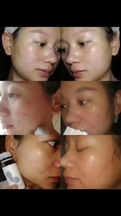 我家顾客用纵美护肤品,胶原蛋白肽前后对比95经过同意我才分享到