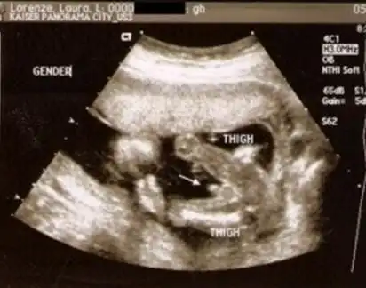 转帖哦,,精心收集男宝女宝b超图片数张!附b超特徵总结!