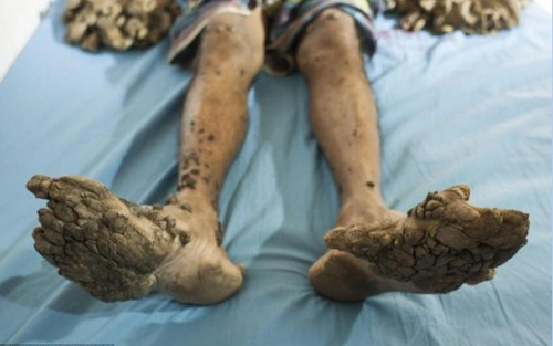 国外男子得一怪病手脚长满树枝去医院检查结果让他全身发抖