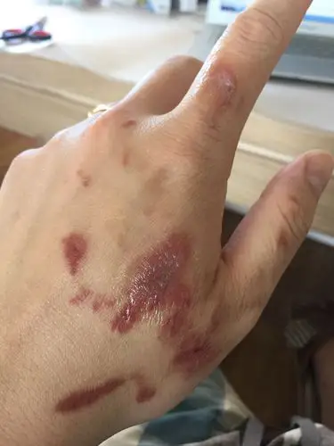 我的手做饭的时候被油水烫伤,第二天起了水泡,之后由于水泡过大我把