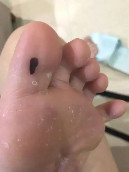 脚底板长出像黑色素的东西,这到底是什么我好害怕!
