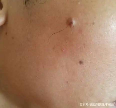 痣上长毛了,能不能拔?