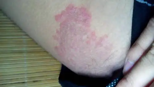 2014-05-16 李磊 医师 我的皮肤瘙痒得不行打