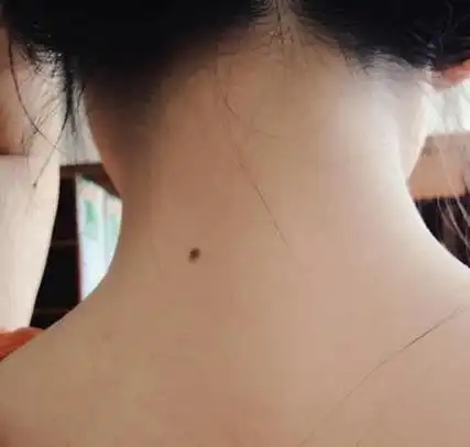脖子上有痣代表什么关于脖子上痣的传说和吉凶