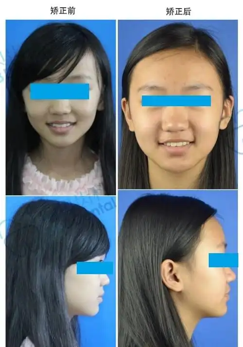 虎牙妹妹矫正,绽放自信笑容