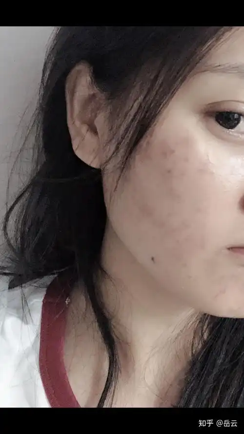 做果酸换肤后一个月皮肤越来越差