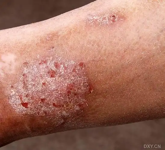 【求助】湿疹求药!