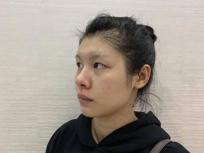 问题天生单眼皮鼻梁低正面露鼻孔
