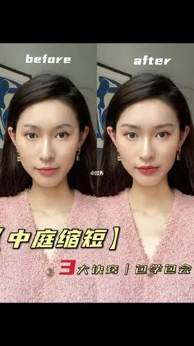 75长脸变精致的366大秘密中庭缩短术