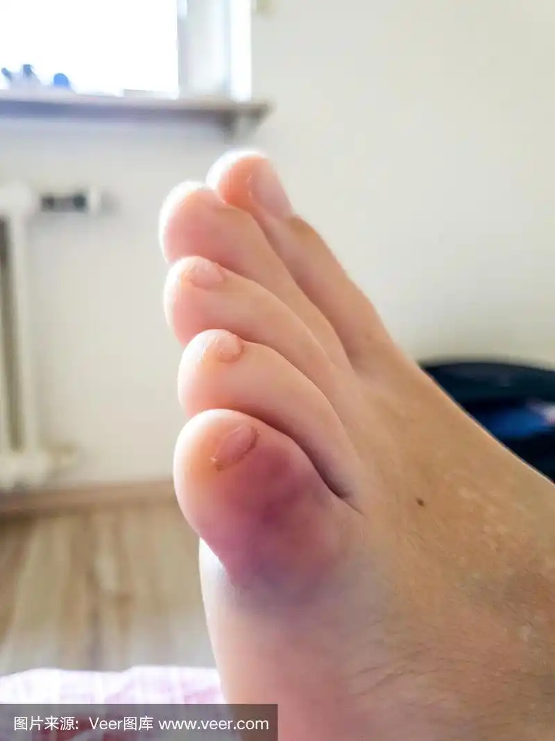 左上小脚趾骨折