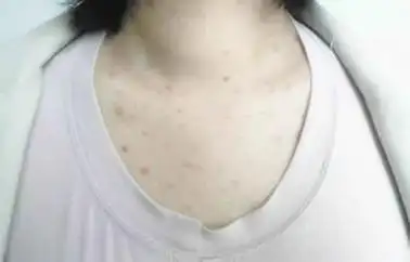 螨虫咬过后的疙瘩照片:一个人对螨虫过敏了怎么办