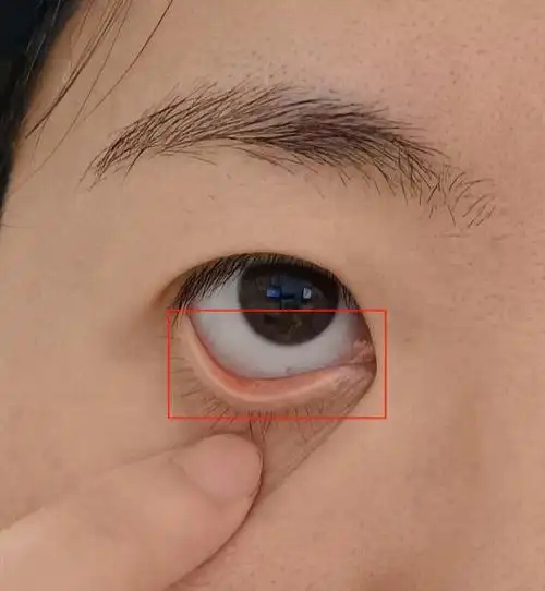 自己的下眼皮,如果颜色为白色(正常人是淡粉色的),那么,你可能贫血了