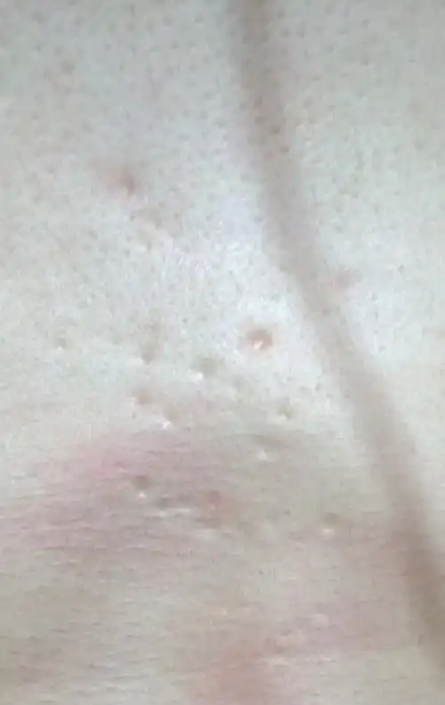 胸前张了许多照片上的痘痘,这是什么东西啊,平时不痛不痒,好几年了