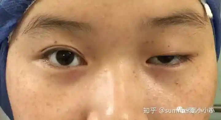 做上眼睑下垂手术是一种怎样的体验? - 知乎