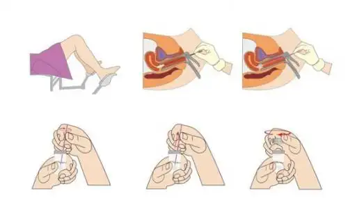 宫颈癌筛查新方法艾迪康自取样hpv检测你了解吗