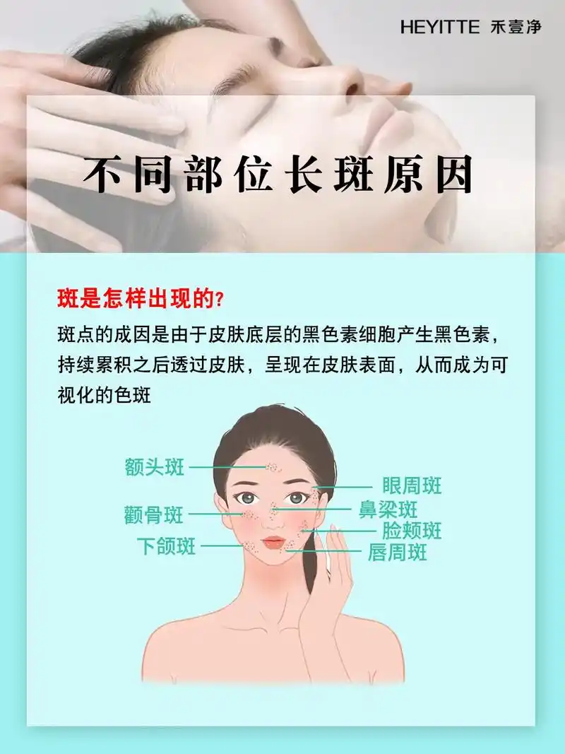 皮肤管理培训 | 脸上不同部位长斑的原因.#美容院加盟 更多 - 抖音