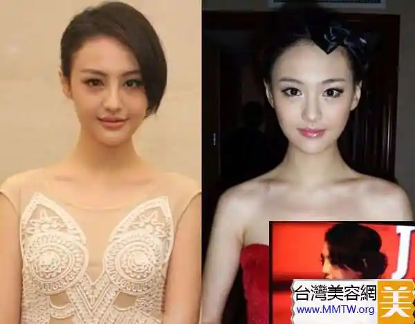 郑爽取出隆鼻假体 整形失败倍感自卑分手