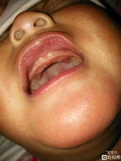 宝宝出牙牙床上有一块白色,牙龈上面白色凸起