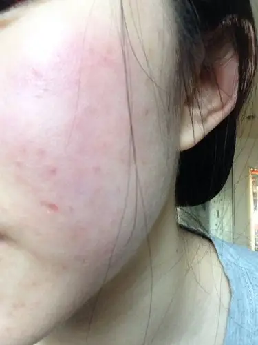 我的脸过敏啦,怎么办啊吃雷他定也不好使