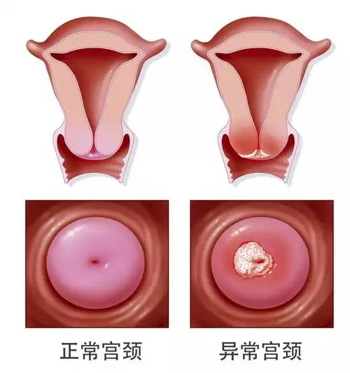 健康关爱女性防治宫颈癌