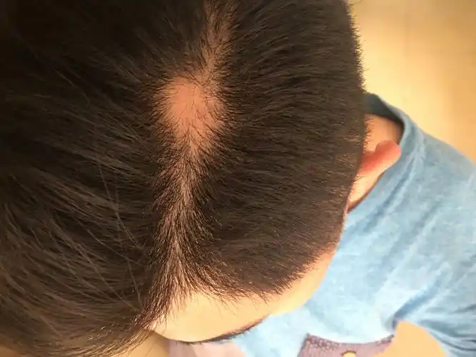 我头顶秃了一块怎么回事