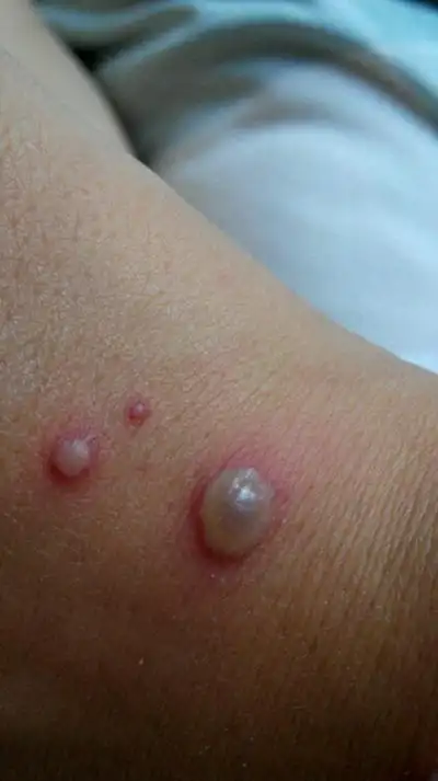 小孩水痘症状图片62