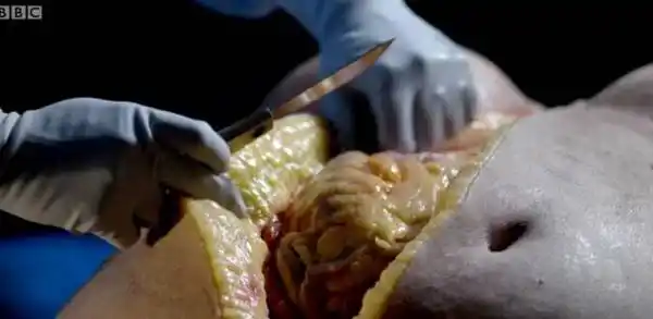 bbc纪录片解剖了一个大胖子,看完大家都想开始减肥了 | 画面刺激慎入