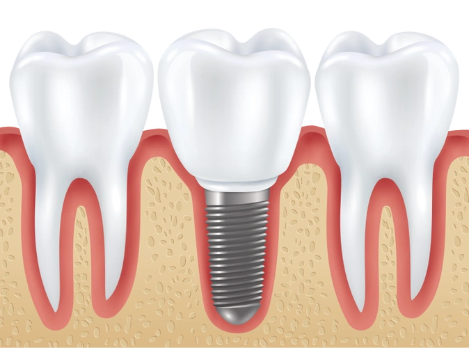 科普种植牙到底能维持多少年