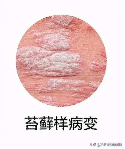 皮炎症状图片(常见皮肤病图片和病名)
