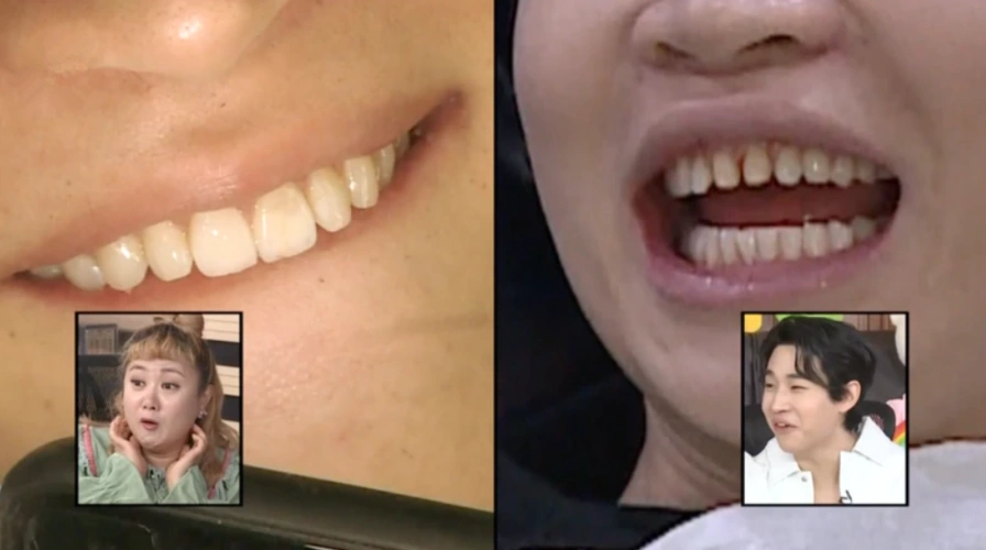 31岁人气男星毫无偶像包袱,上节目首度展示蛀牙,坦言害怕洗牙_腾讯