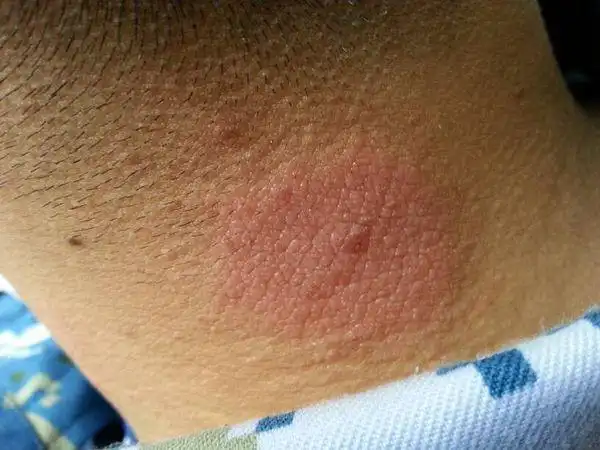 脖子后面起了一个跟癣一样的东西,麻烦大夫