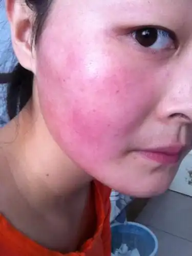 发红发热.中午去医院检查.医生说我说过敏性皮炎.开了药.