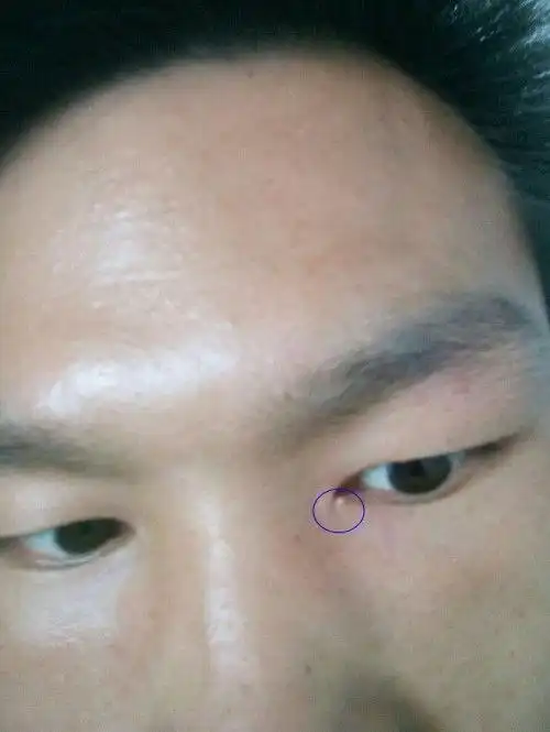 眼皮上长了个小白疙瘩 - 搜狗图片搜索