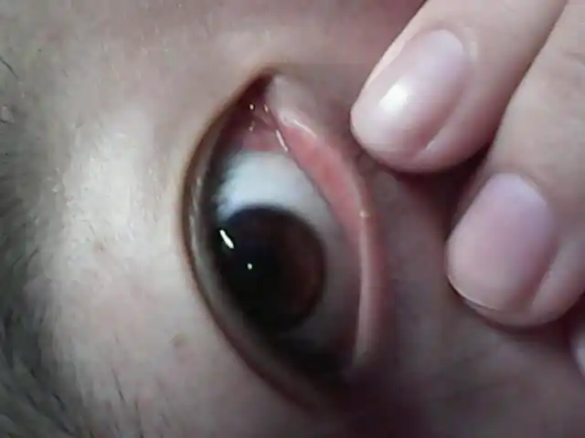 下眼睑长了一小粒东西.不痛不痒眨眼也没有异物感,这是啥?需要治疗不