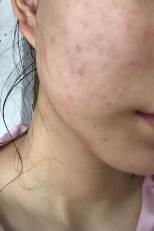 我这是过敏了吗还是长痘痘?