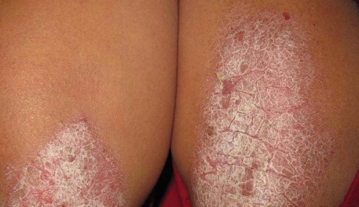 体股癣初期现象图片 (32)