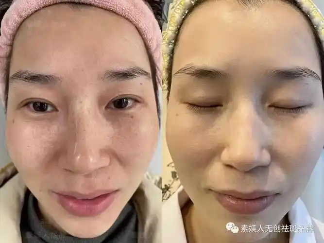 加盟我们-素媄人无创祛斑-湖南梵慕美容有限公司